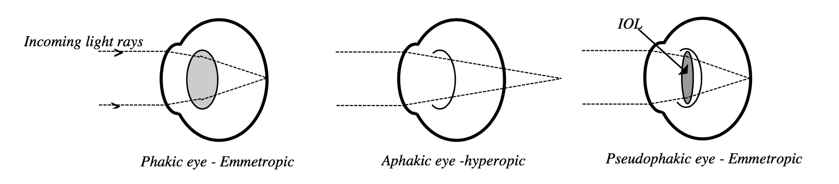 Lens optics