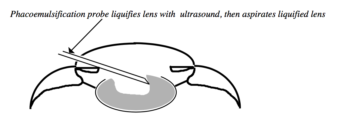 Phacoemulsification