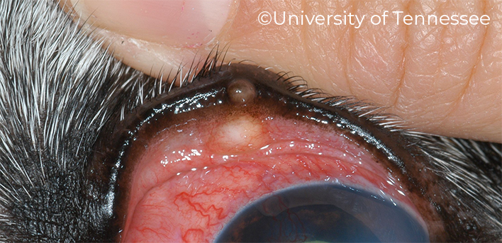 Upper Eyelid Chalazion