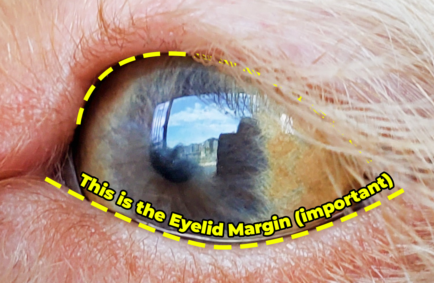 Normal Eyelid Margin
